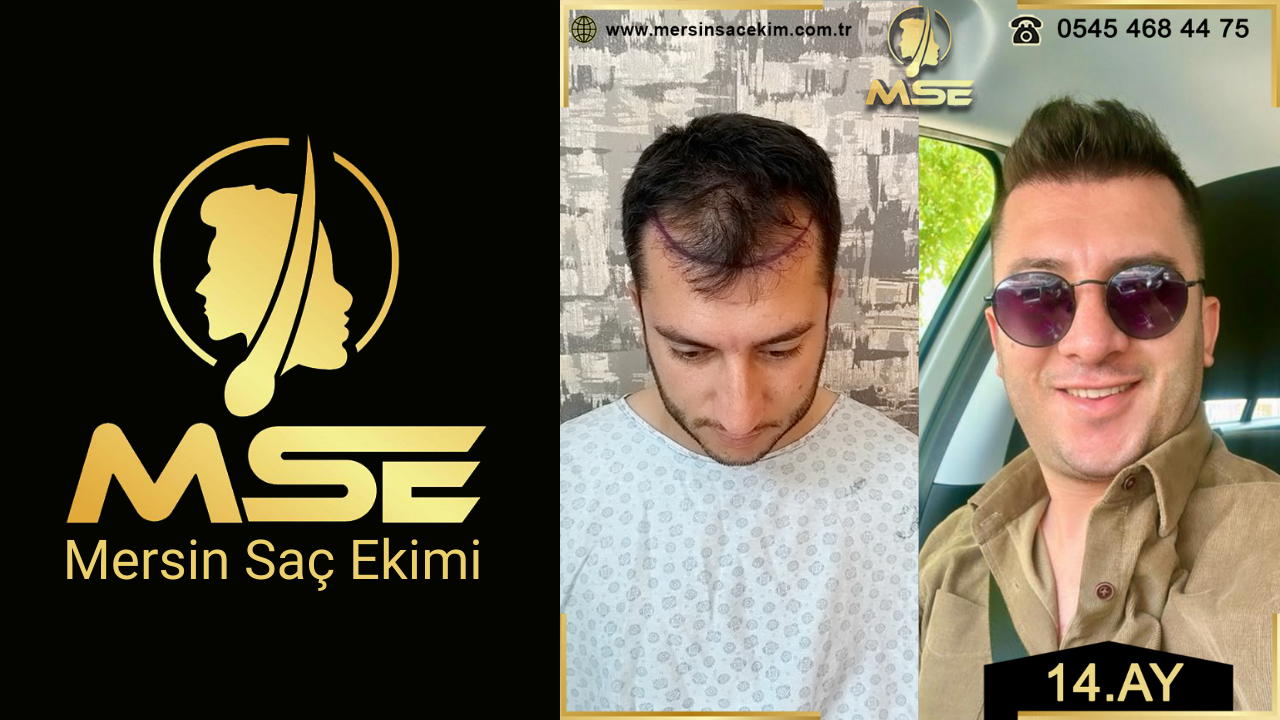 Mersin Saç Ekimi